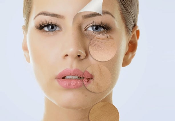 peels hyperpigmentation